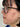 Woman with acne on her face