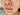 dermatitis around the nose