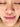 Eczema on the face