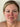 Woman with skin redness and rosacea