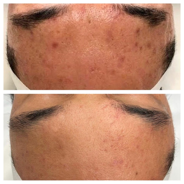 Acne & Scars: Charlie's Skin Journey