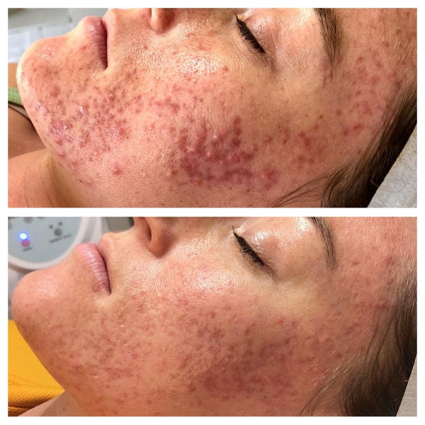 Acne: Katie's Skin Journey