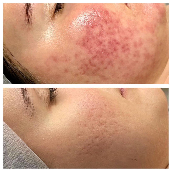 Scars: Carissa's Skin Journey