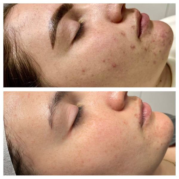 Acne: Jess's Skin Journey